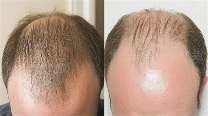 Can you reverse baldness