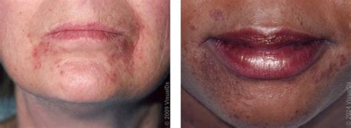 Does perioral dermatitis look like acne