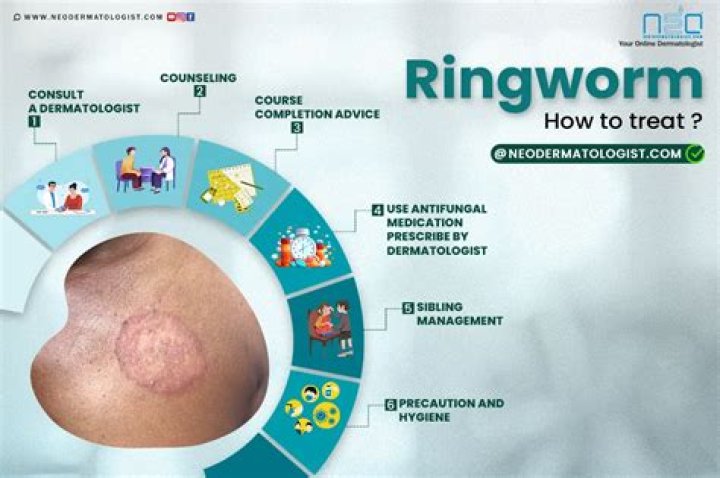 How do you treat ringworm on babies