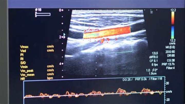 How is a venous Doppler done