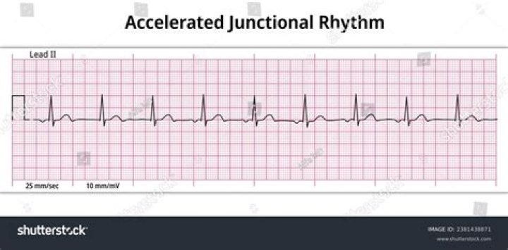 How is junctional rhythm treated