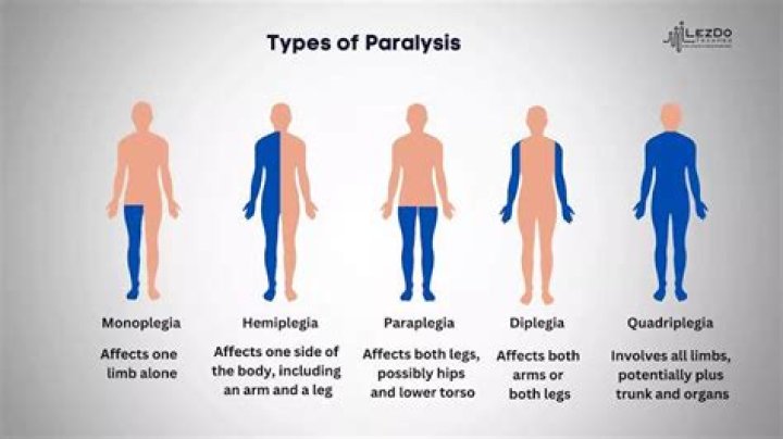 Is paralysis and paralyzed the same thing