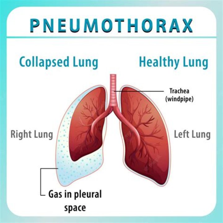 What causes a simple pneumothorax