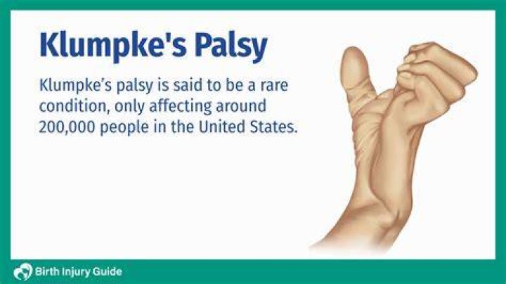 What causes Klumpke palsy?