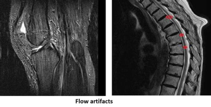 What is a flow artifact