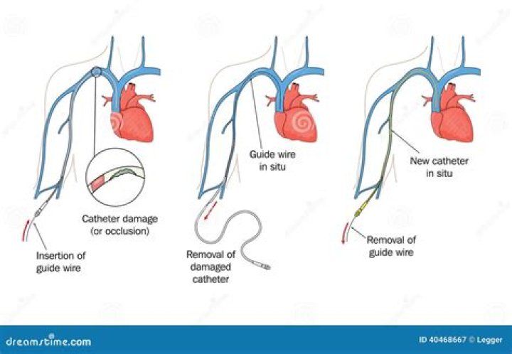 What is a Hohn catheter