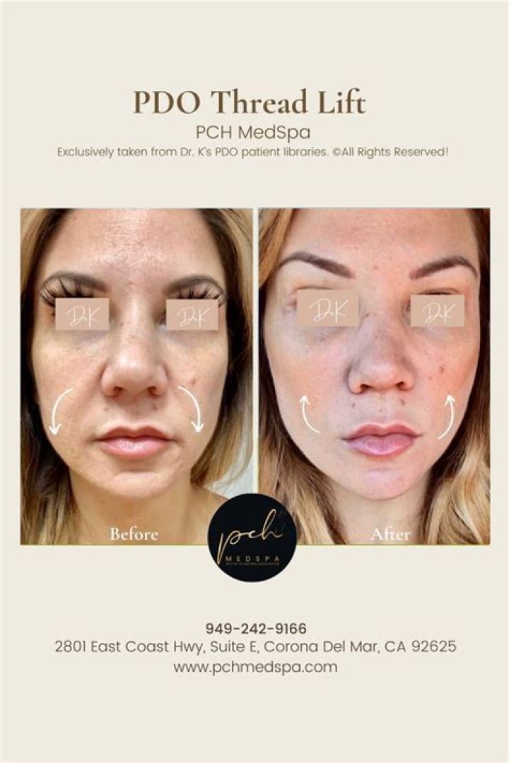 What is a sugar thread lift