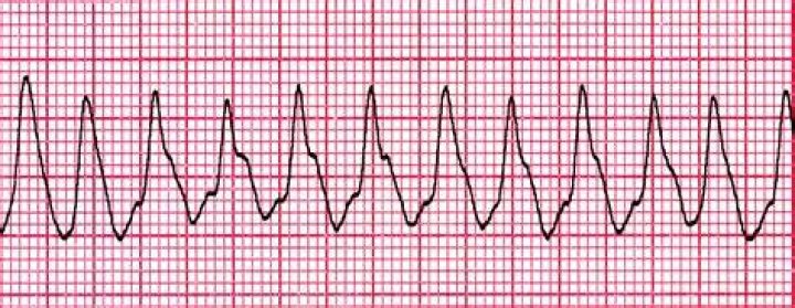 What is a vector ECG