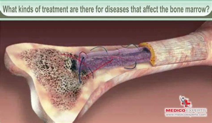 What is bone marrow damage