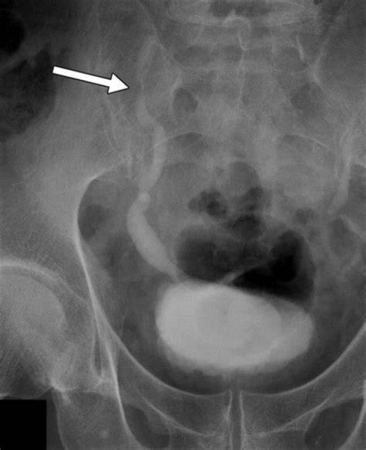 What is excretory urography