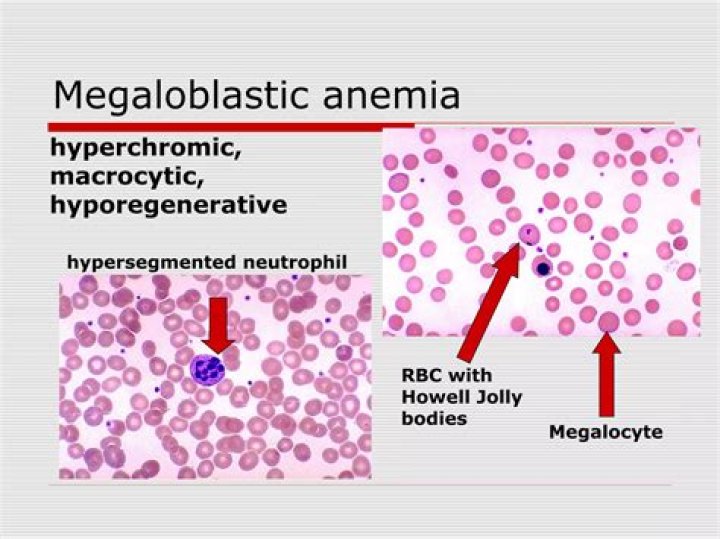 What is Hyporegenerative anemia