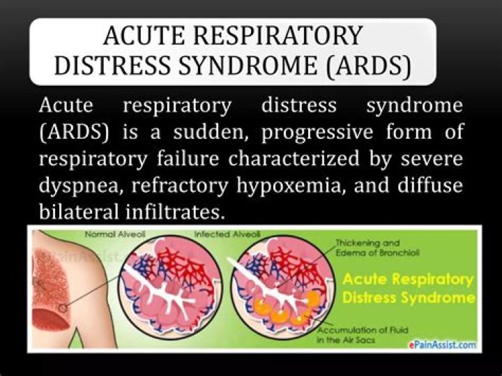 What is refractory hypoxemia in ARDS
